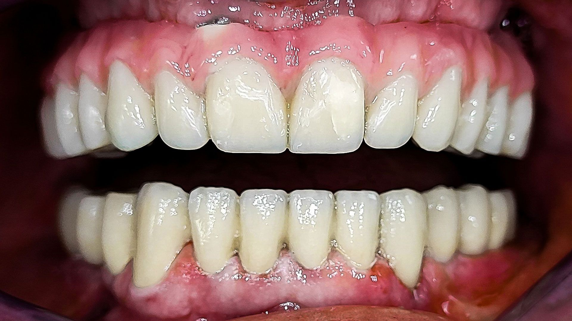 Dopo tecnica all on six - denti in croazia