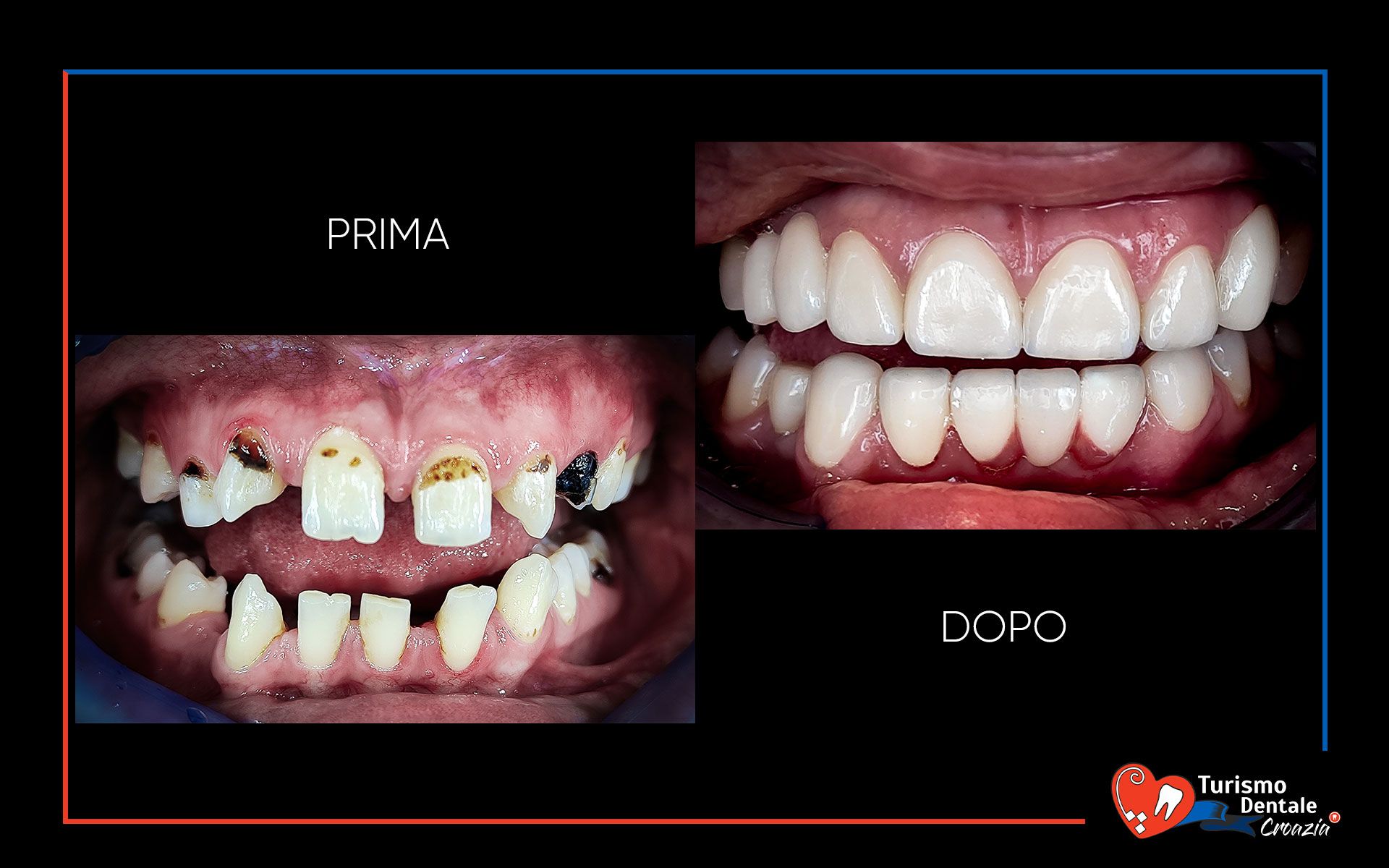 Impianti dentali prima e dopo esempio #3