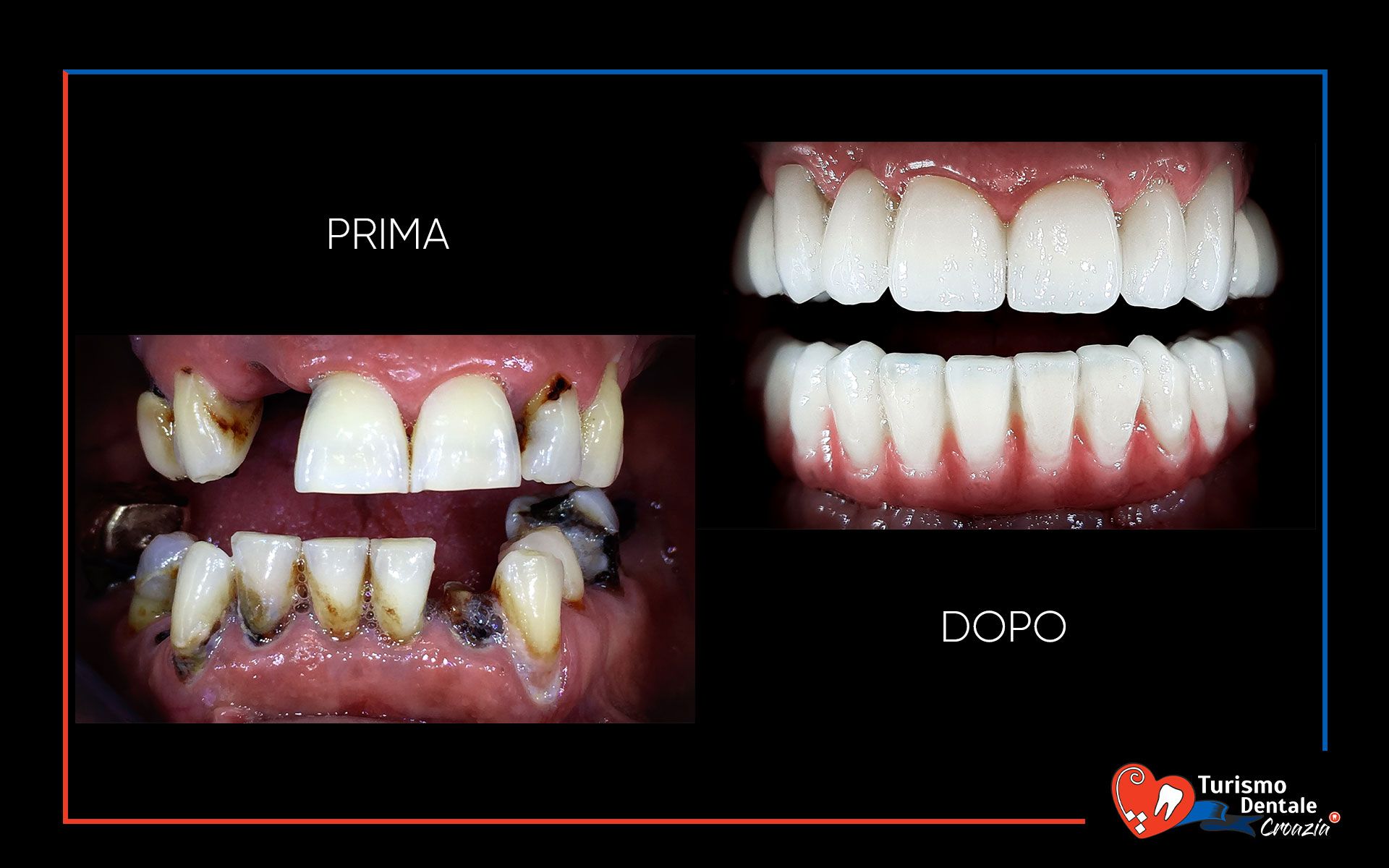 Impianti dentali prima e dopo esempio #1
