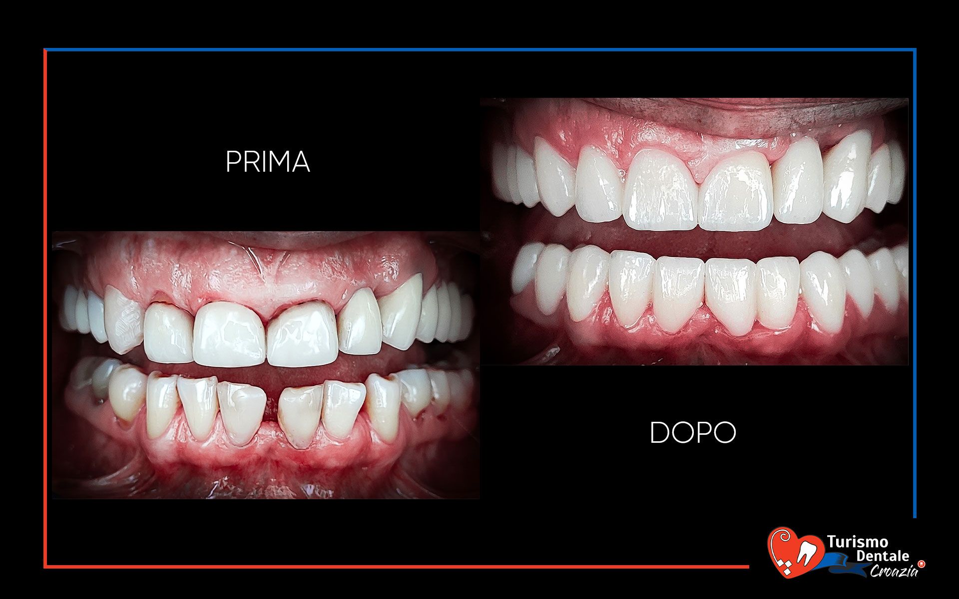 Impianti dentali prima e dopo esempio #2