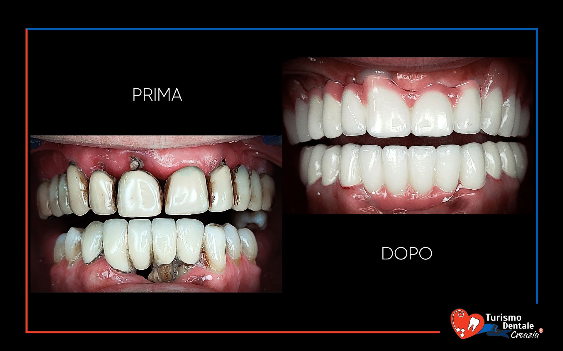Impianti dentali prima e dopo esempio #4