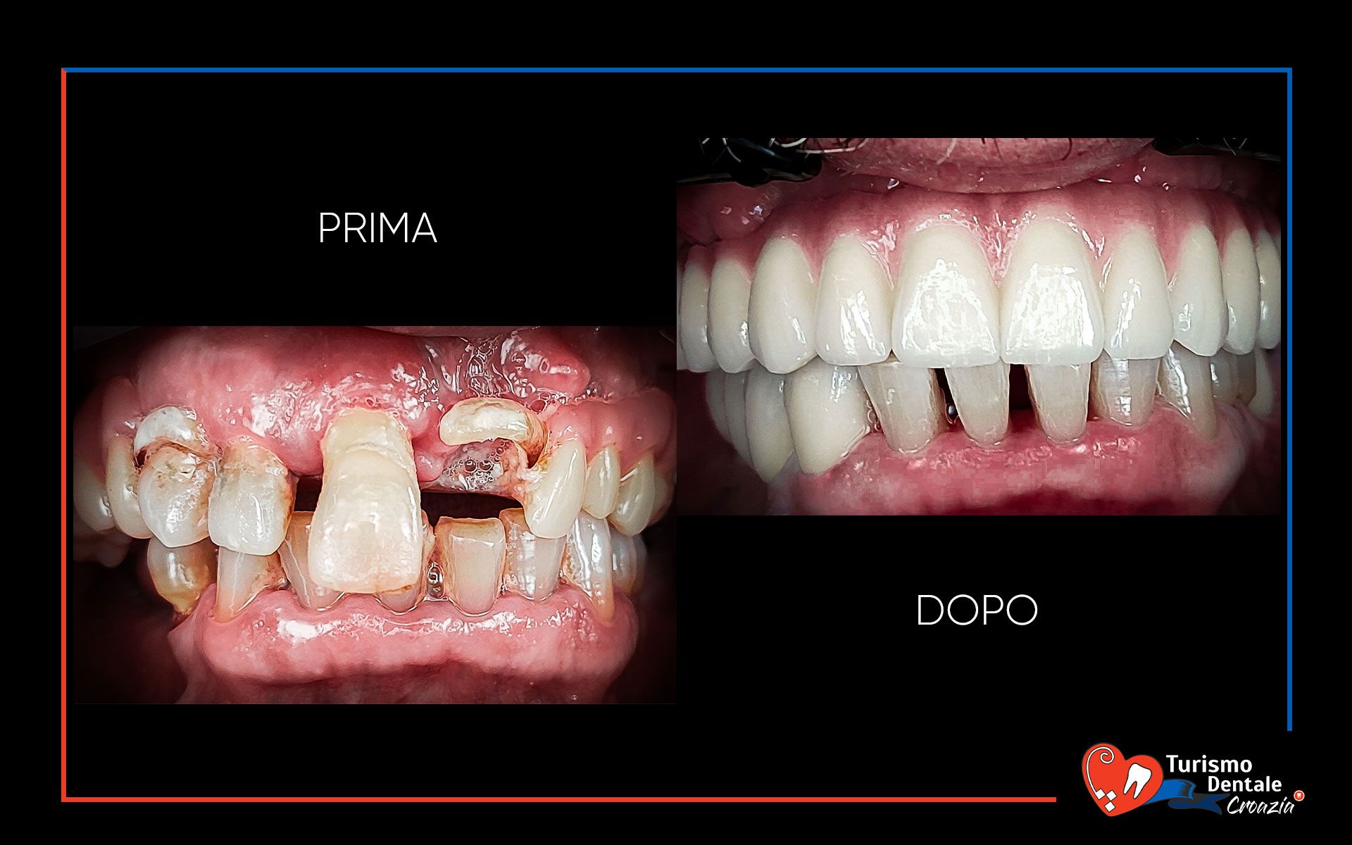 Impianti dentali prima e dopo esempio #5