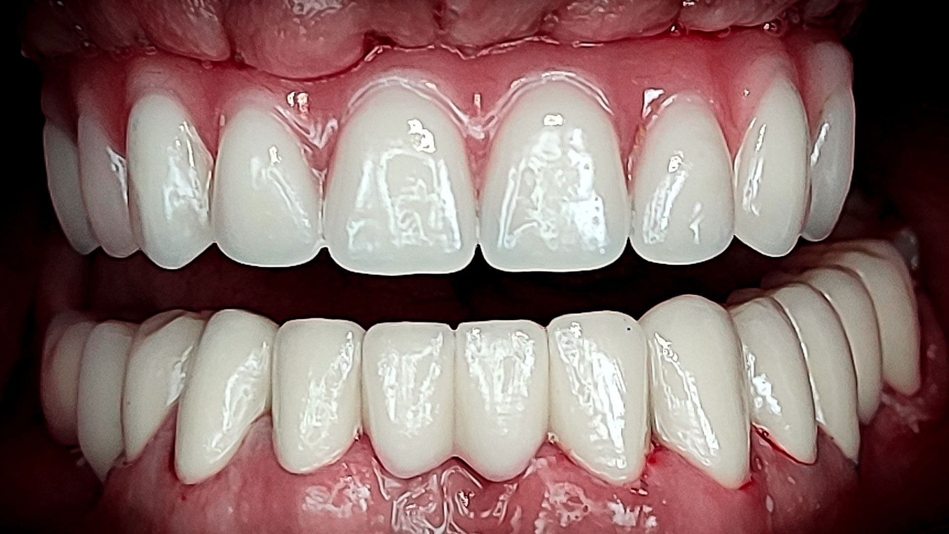 Impianto dentale prezzi - 300€ in Croazia, dopo