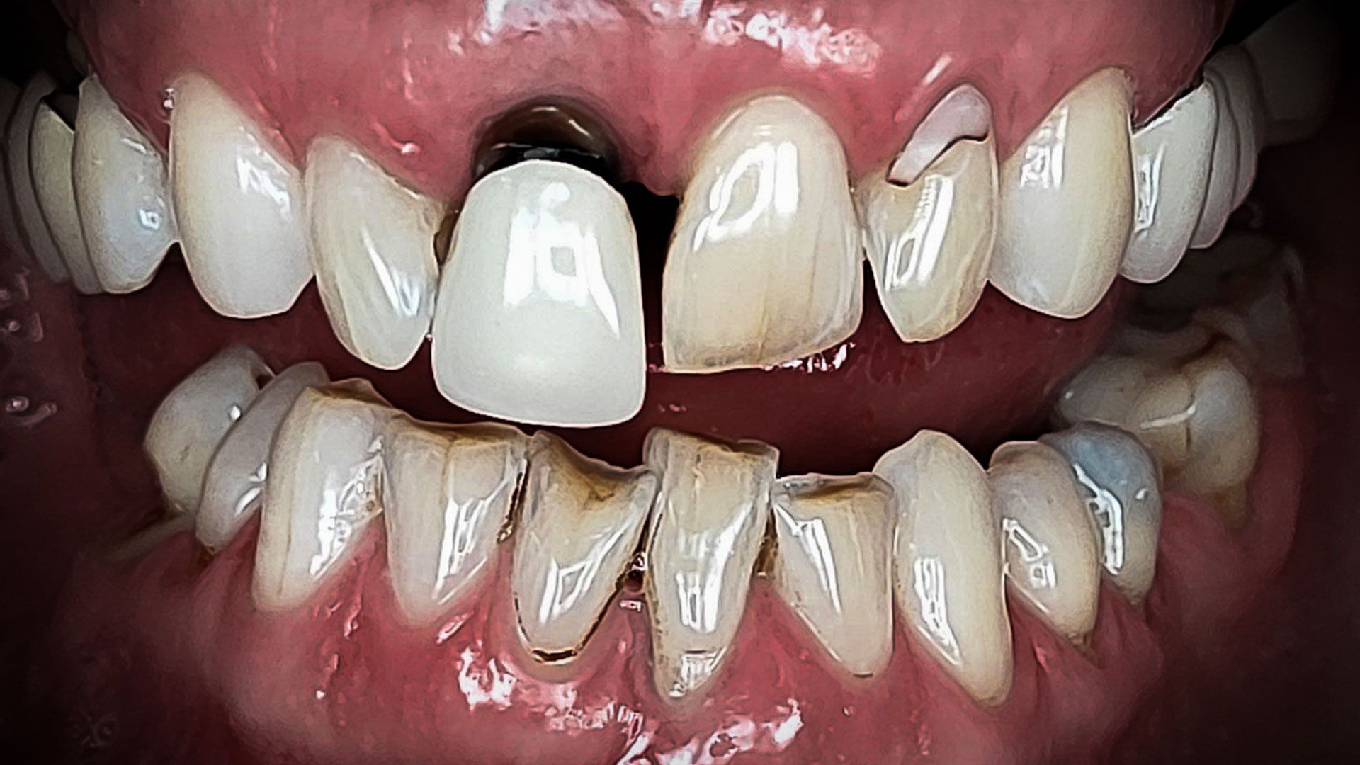 Impianto dentale prezzi - 300€ in Croazia, prima