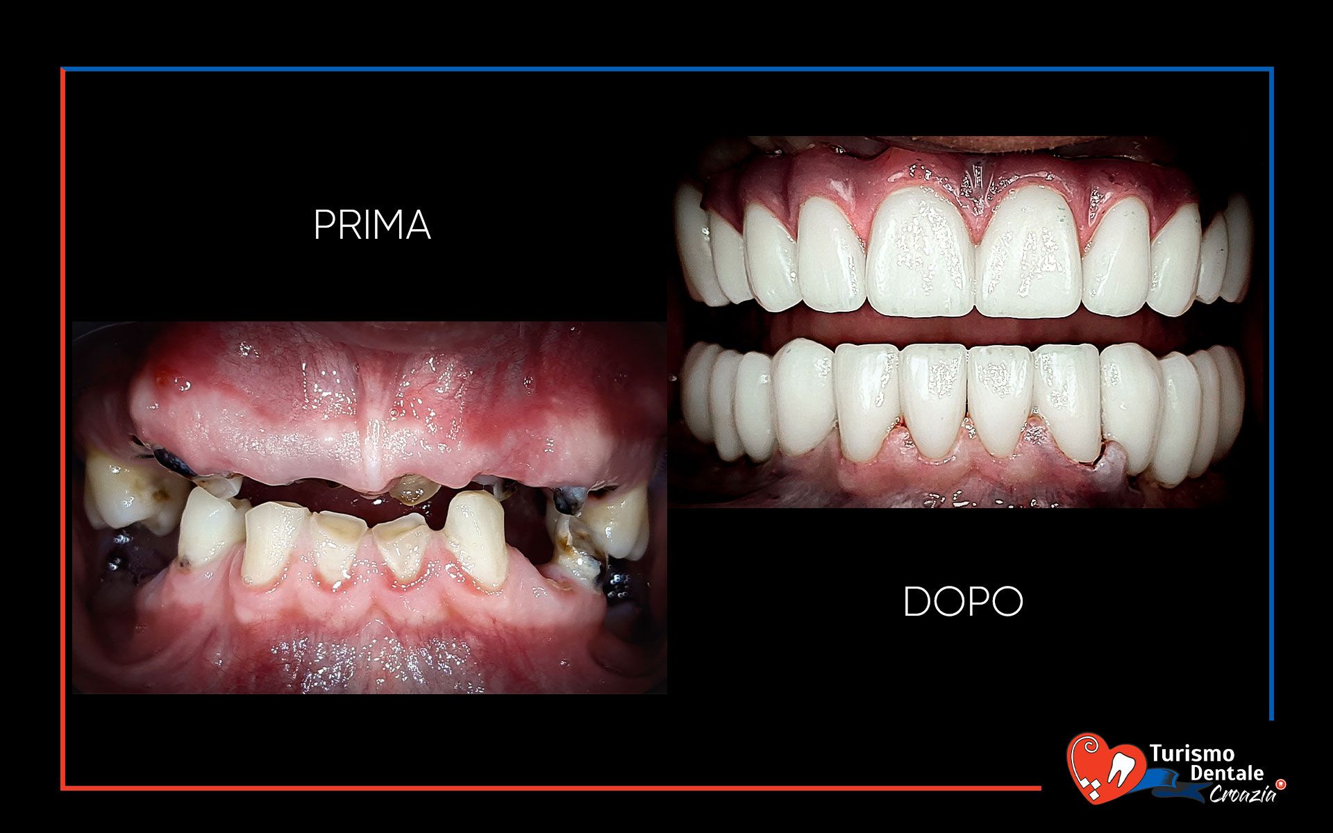 Impianti dentali prima e dopo esempio #6