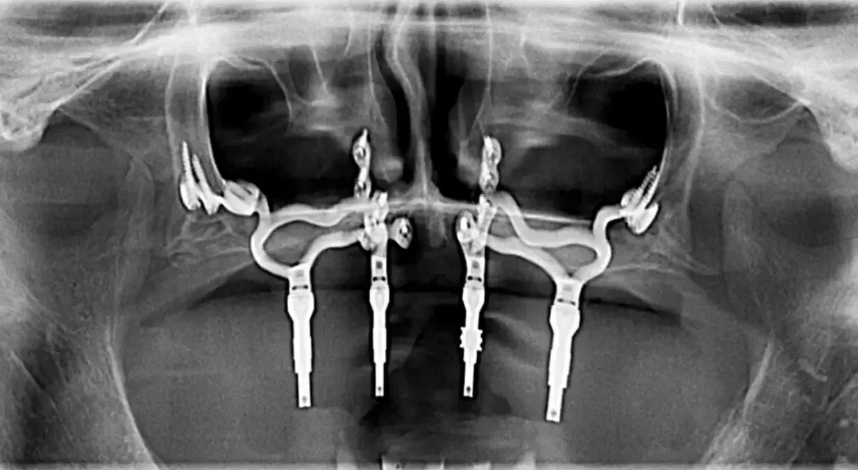 Scopri-gli-impianti-sottoperiostei-denti-fissi-senza-osso