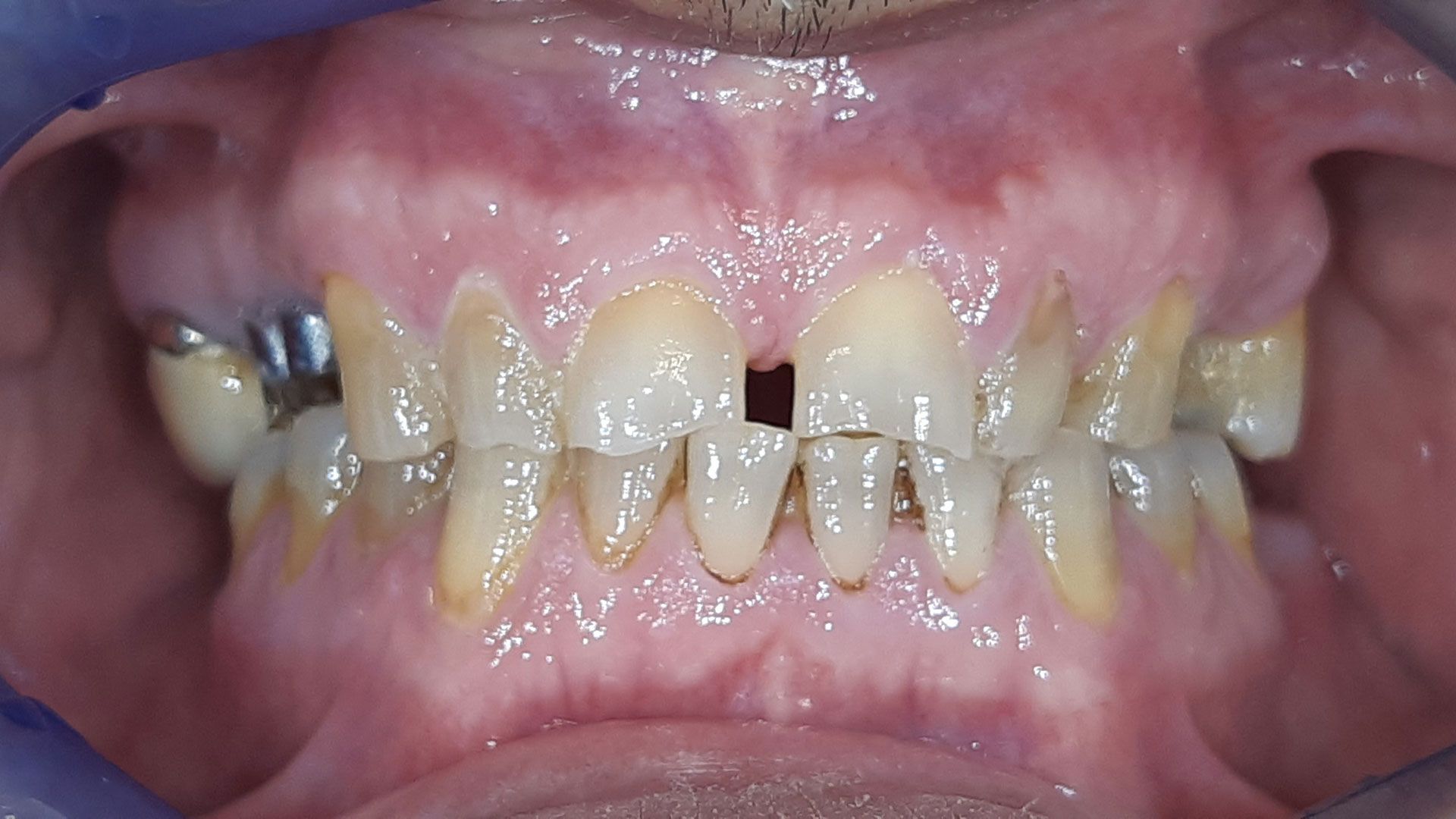 Un primo piano dei denti di una persona con un buco nel mezzo.