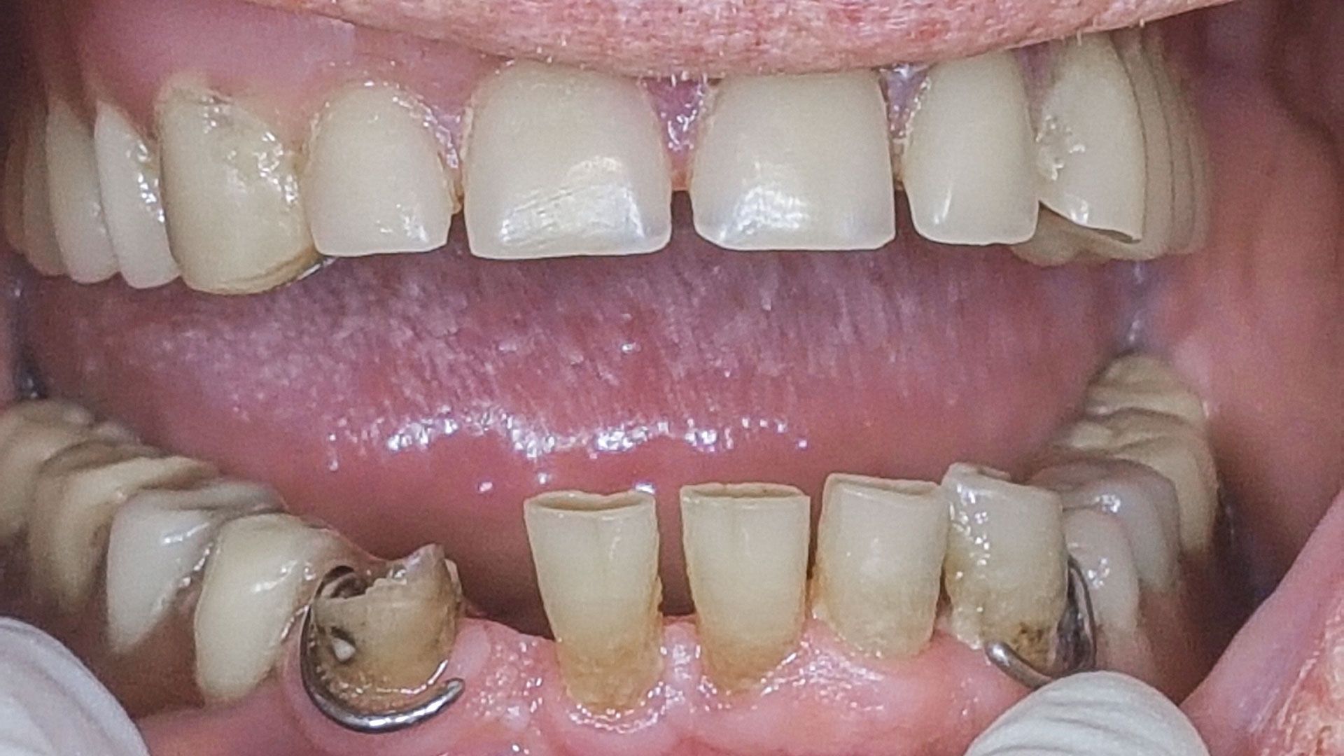 Un primo piano della bocca di una persona a cui mancano molti denti.