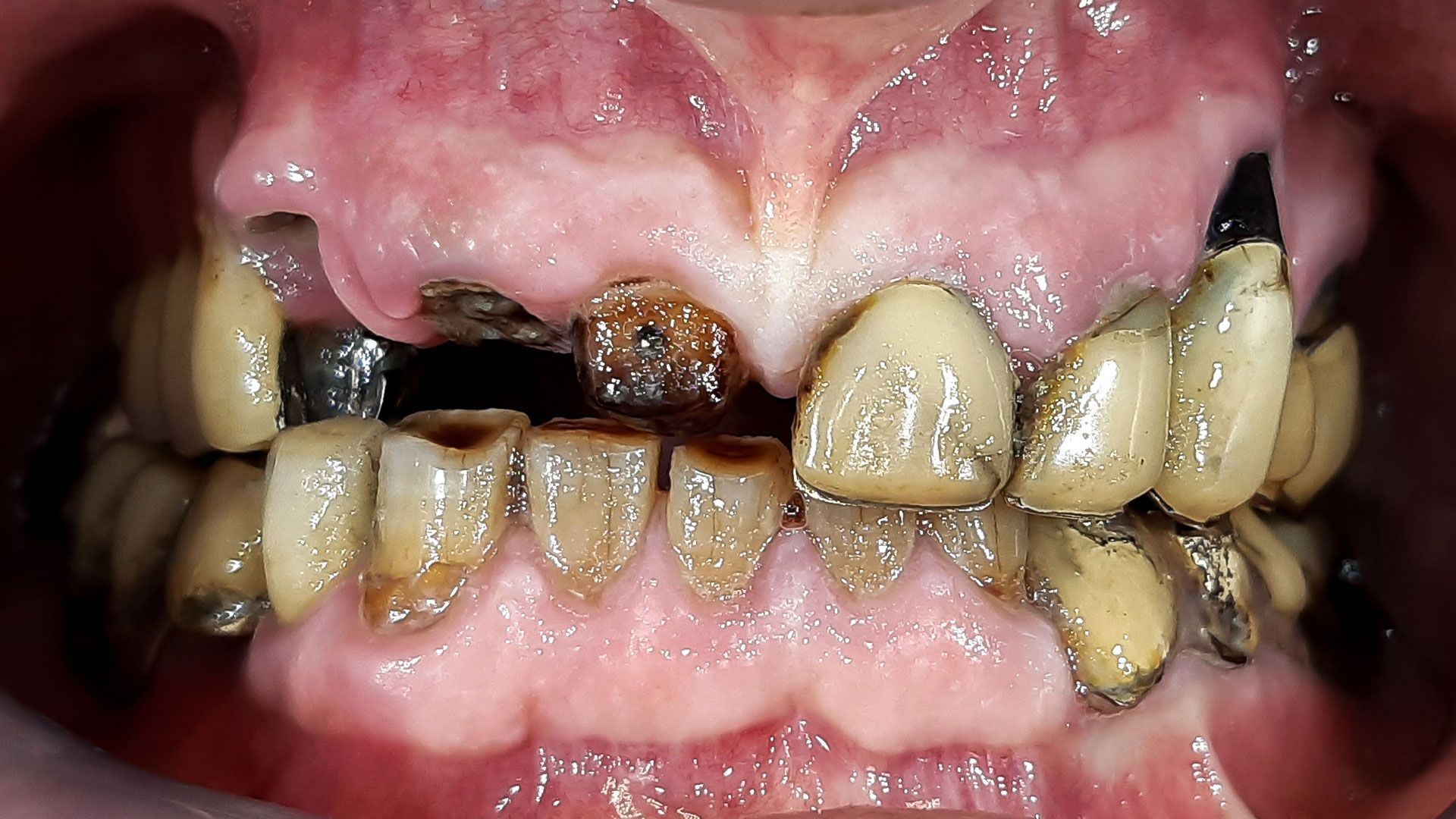 Prima tecnica all on six - denti in croazia
