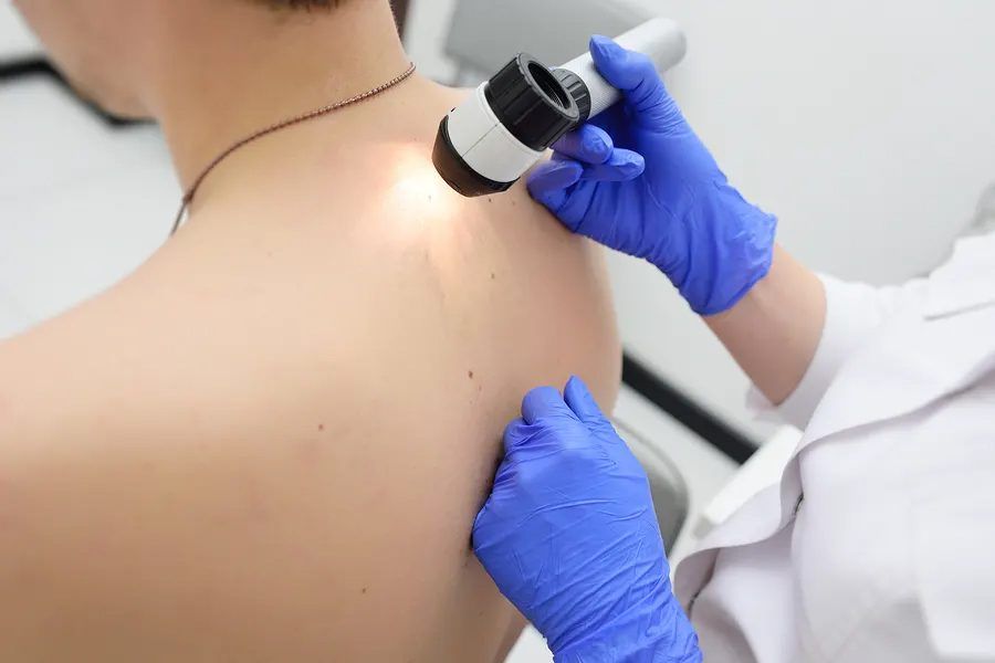 MAPPATURE NEVI CONGENITI