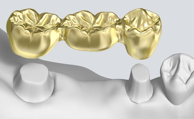 Zahnbrücke aus Edelmetall (Gold)
