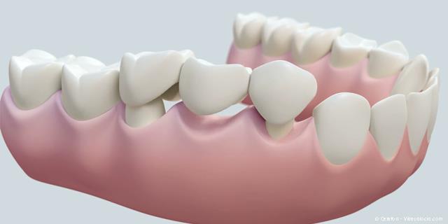 Wie eine Zahnbrücke auf den Zähnen befestigt wird