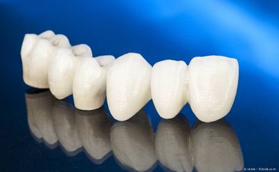 Zahnbrücke aus Keramik zum Ersatz fehlender Zähne