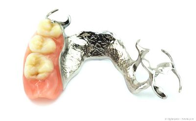 Klammer-Prothese: Der herausnehmbare Zahnersatz bekommt seinen Halt über Klammern an den Restzähnen.