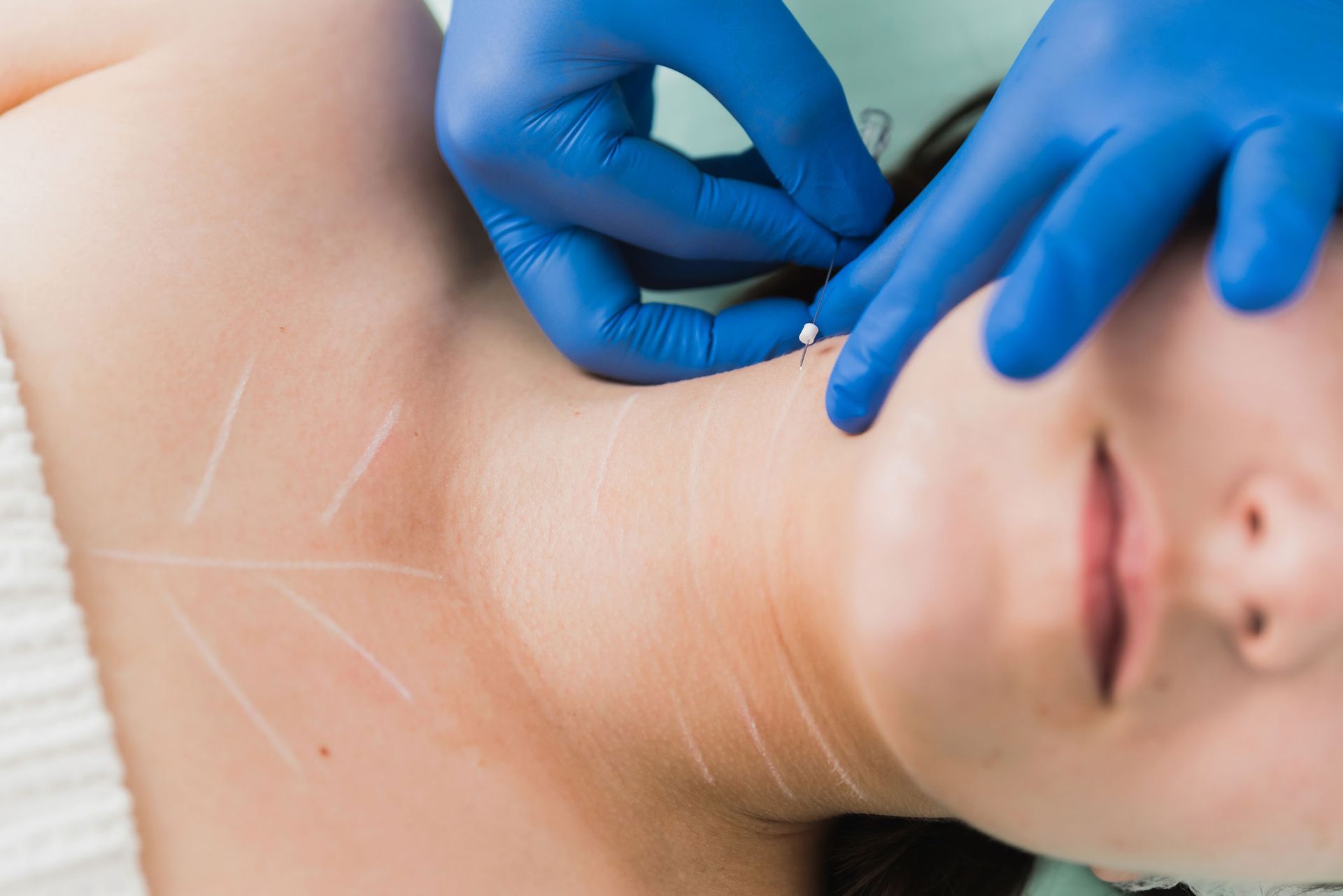 Person receiving a cosmetic procedure on their neck, gloved hands hold a needle, white lines mark the skin. Person receiving a cosmetic procedure on their neck, gloved hands hold a needle, white lines mark the skin.