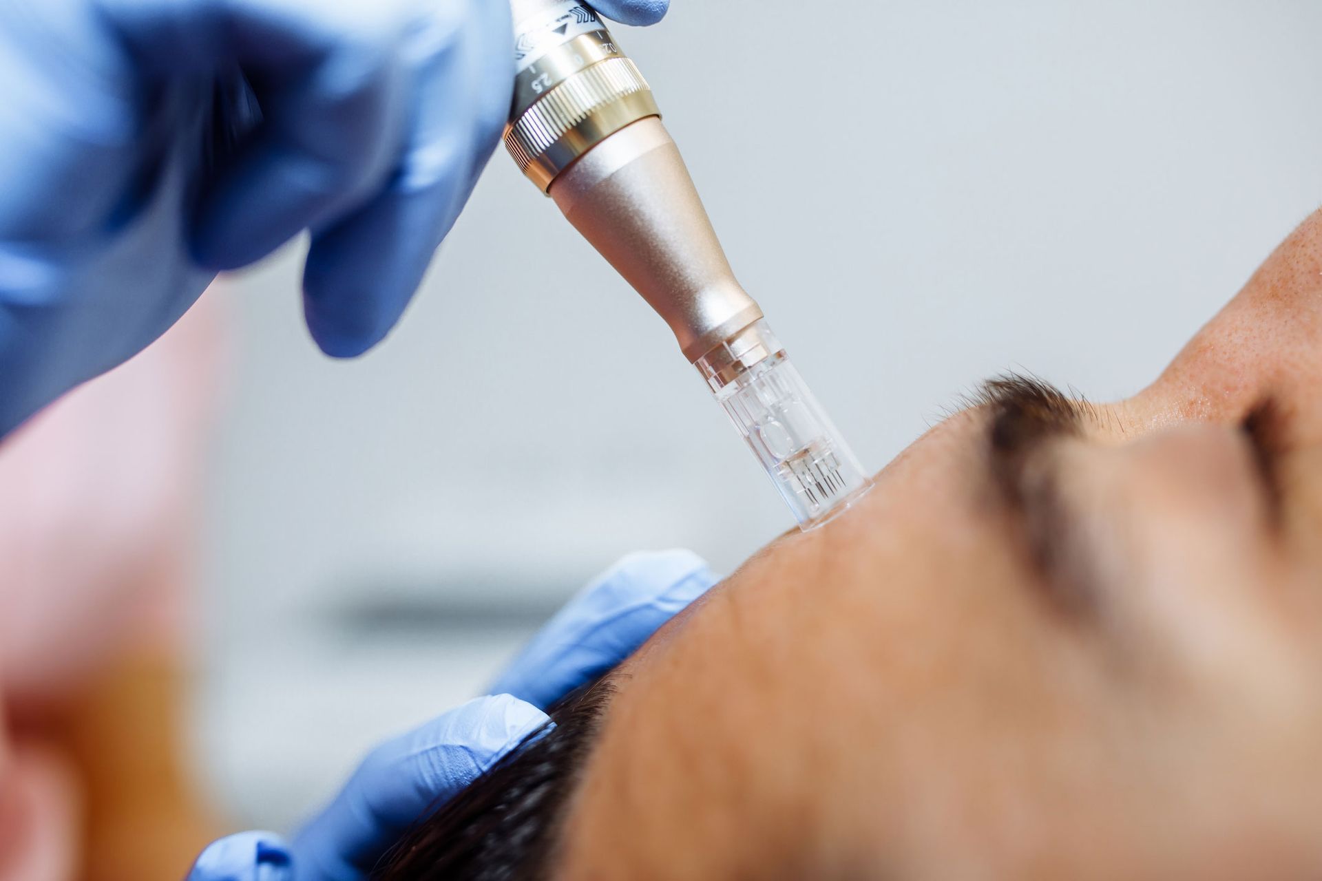 Person receiving microneedling treatment on the forehead, held by gloved hands.