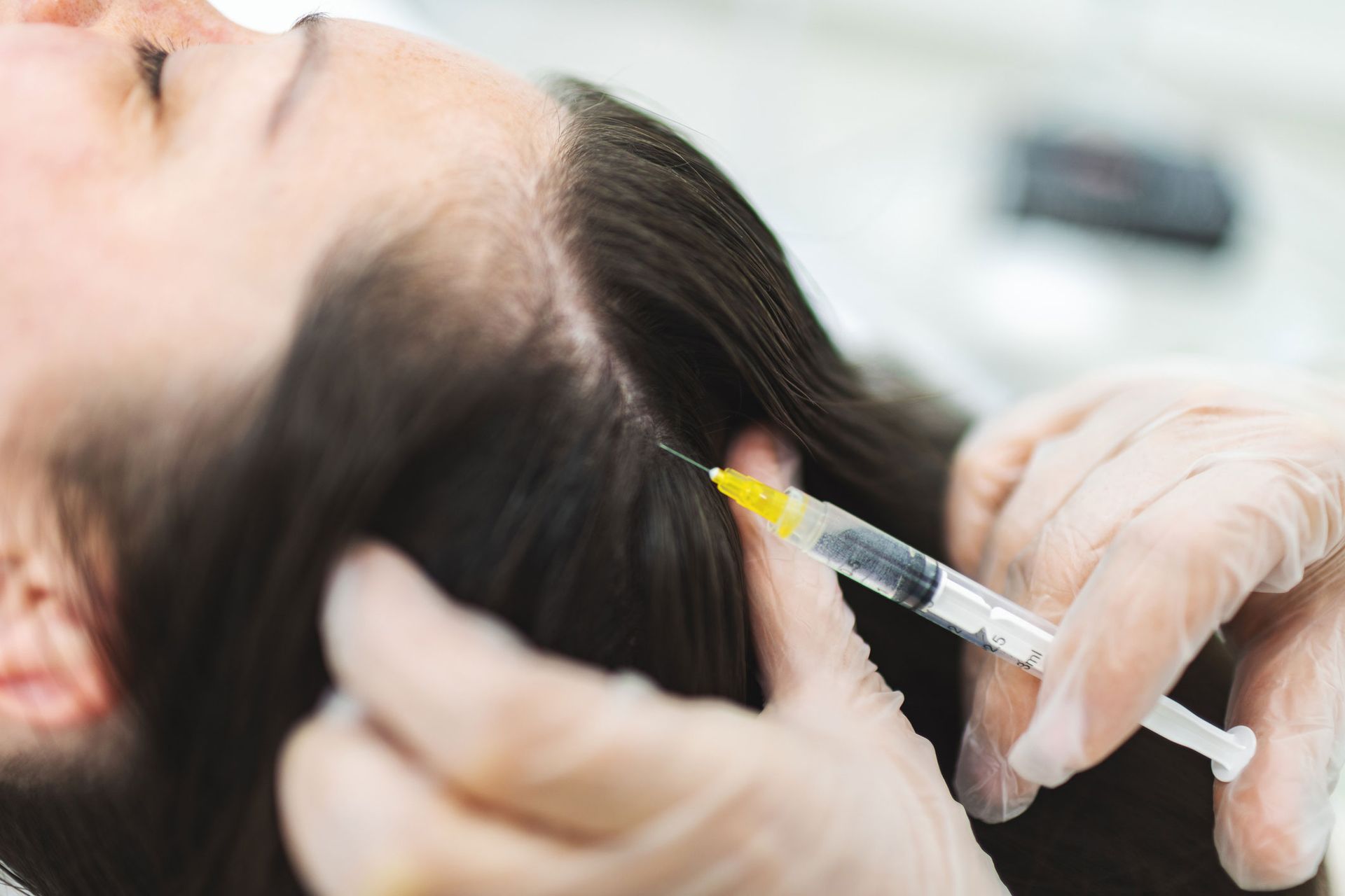 A gloved hand injects a liquid into a person's scalp, near parted brown hair, in a clinical setting.