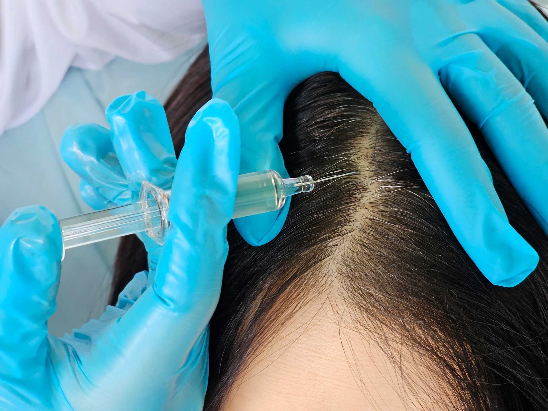 Person receiving scalp injections from someone wearing blue gloves.