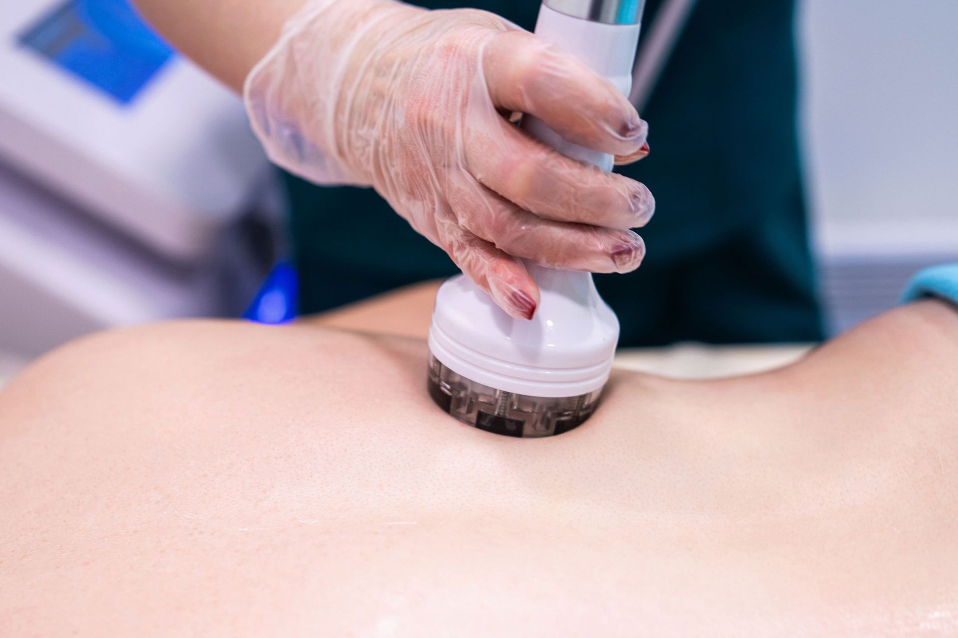 Gloved hand using a device on a person's back, likely for a body treatment.