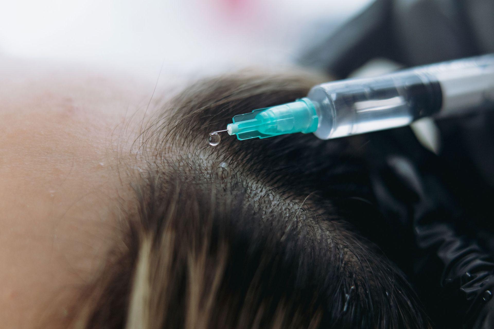 Syringe injecting liquid into scalp, close-up.