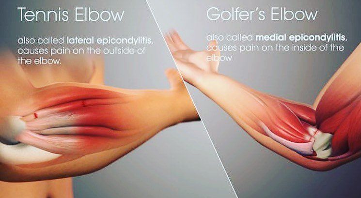 Tennis and Golfer's Elbow