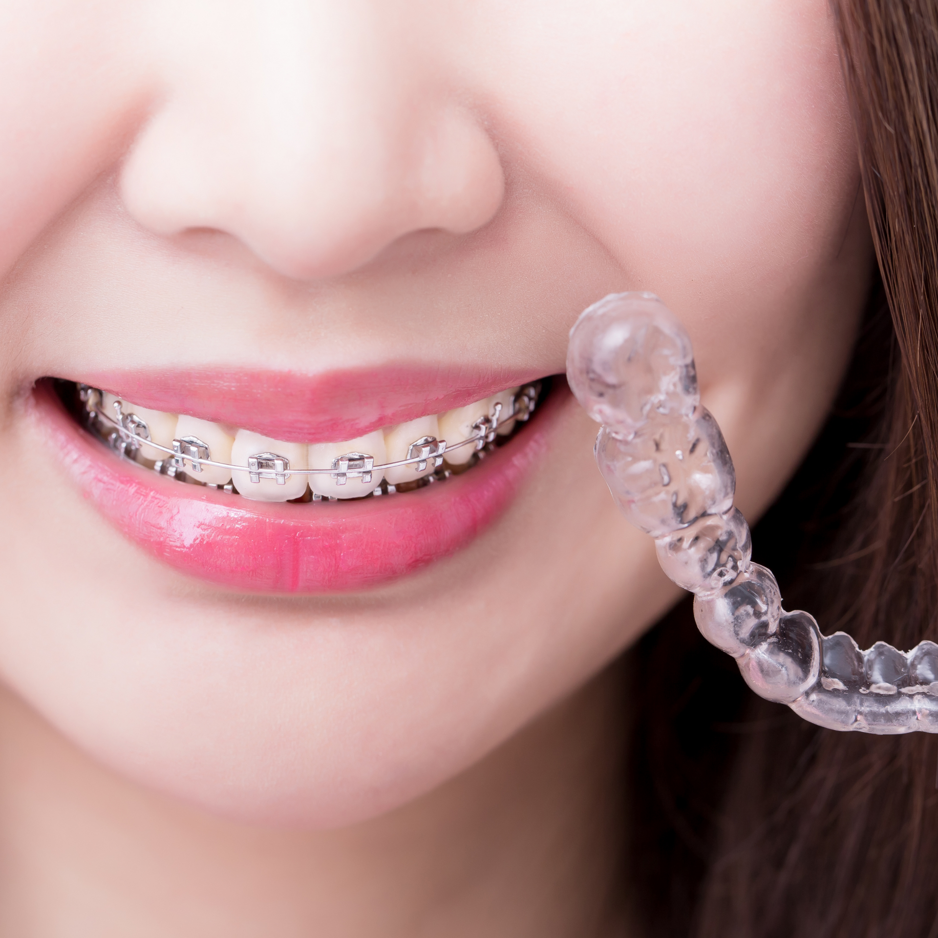 Woman smiling with traditional braces and holding clear aligners for comparison.