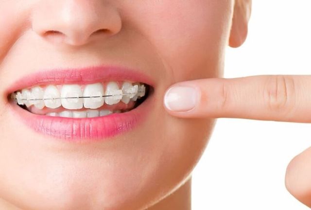 Get a Straighter Smile with Clear Braces  Uplands Dental in Thornhill,  Ontario — Uplands Dental