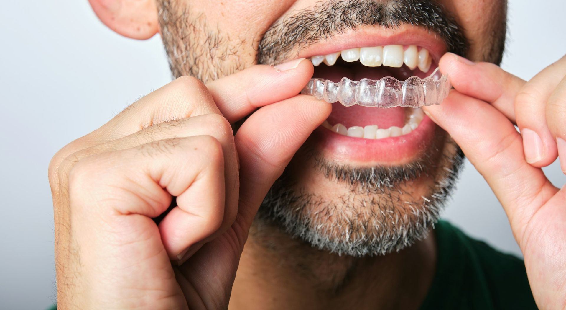 A man with a beard is putting a clear brace on his teeth.