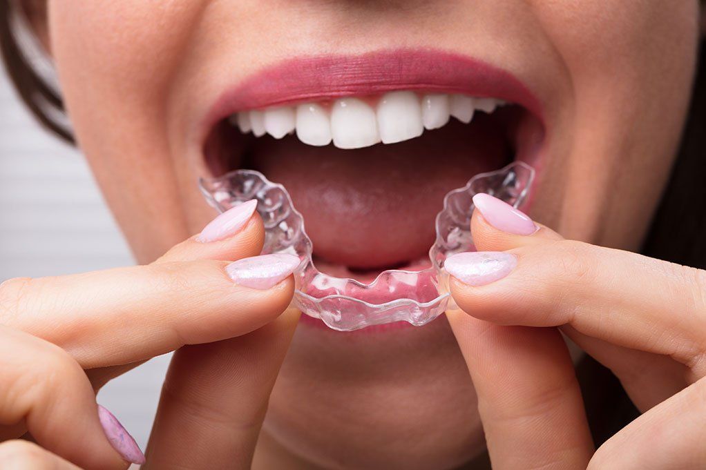 Invisalign braces in Olathe, Overland Park and Spring Hill