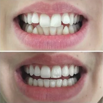 Invisalign results in Olathe, Overland Park and Spring Hill