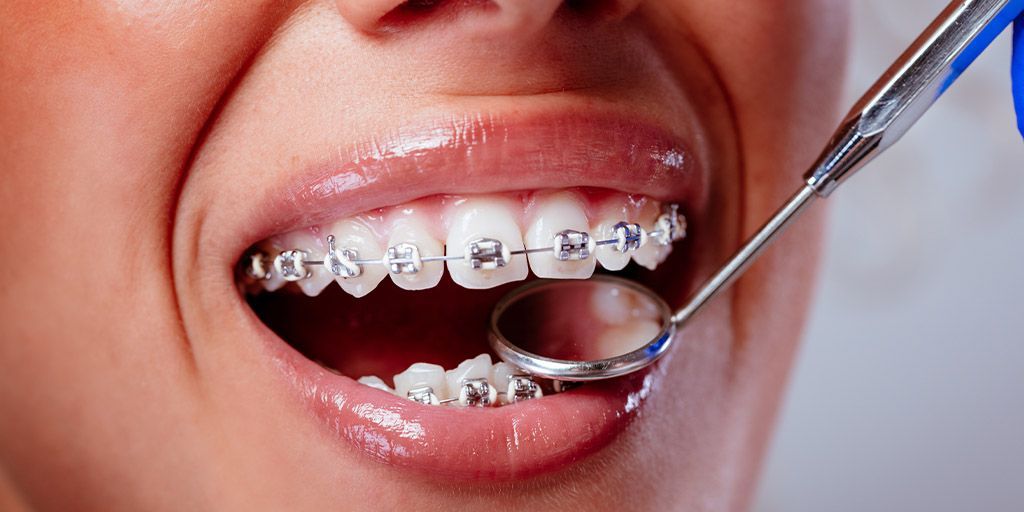 A woman with braces is getting her teeth examined by a dentist.