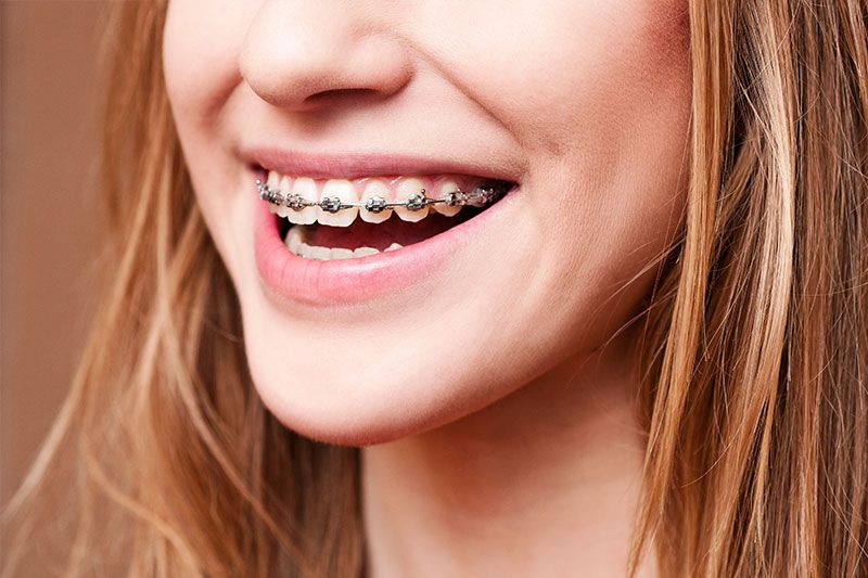 A close up of a woman 's mouth with braces on her teeth.