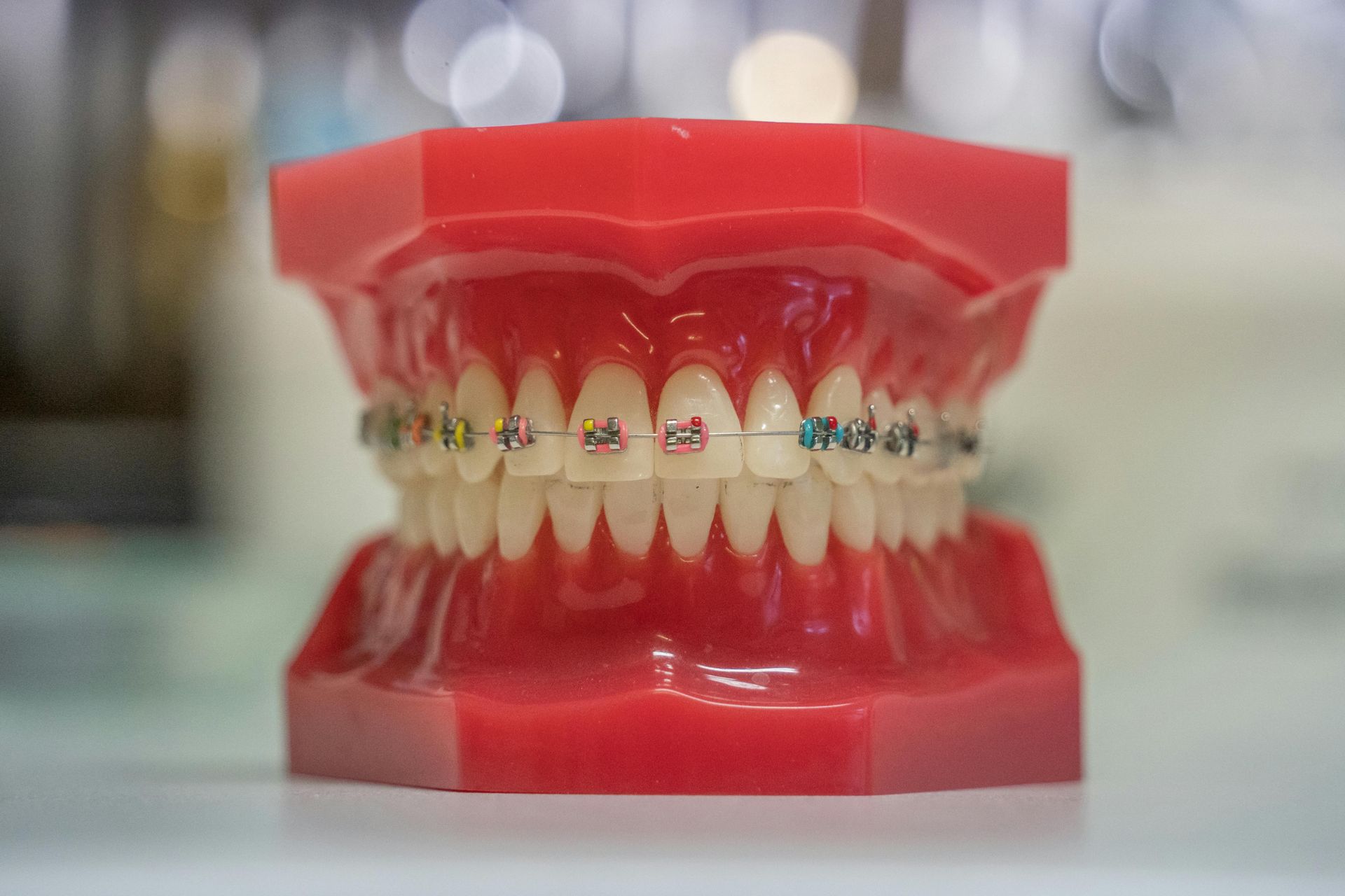 Model of teeth and gums with braces on the top row of teeth