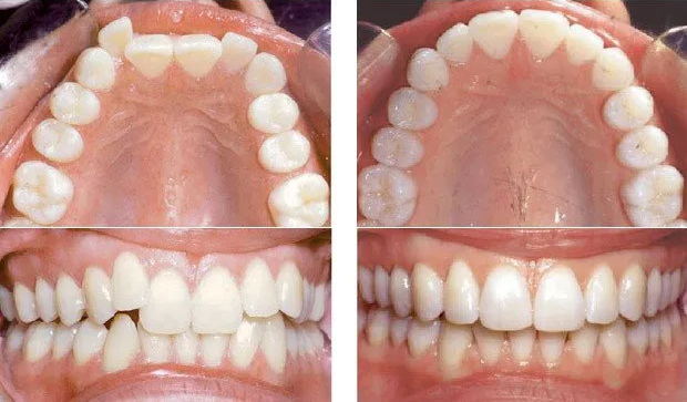 Before and After | Invisalign | Braces | Dentist in Spring Hill KS