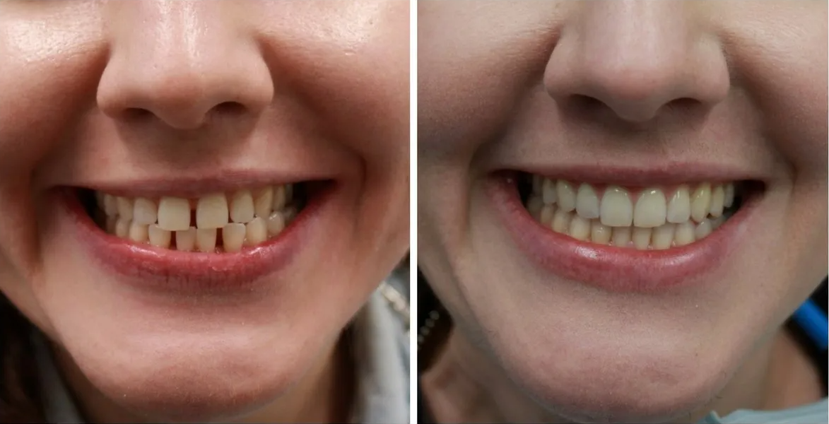 Before and After Image | Invisalign Spring Hill, Overland Park, Olathe KS