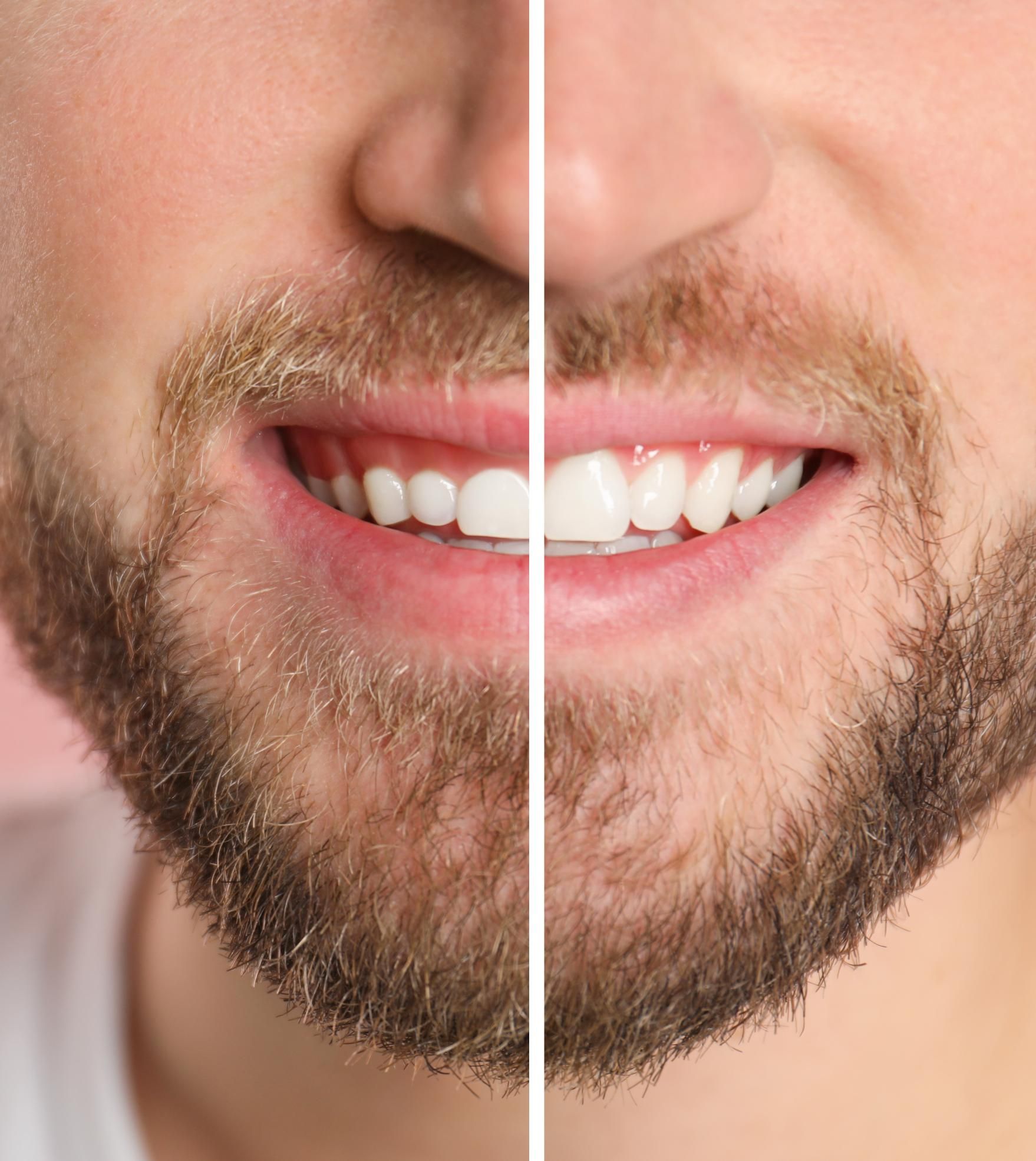 A man with a beard is smiling before and after whitening his teeth.