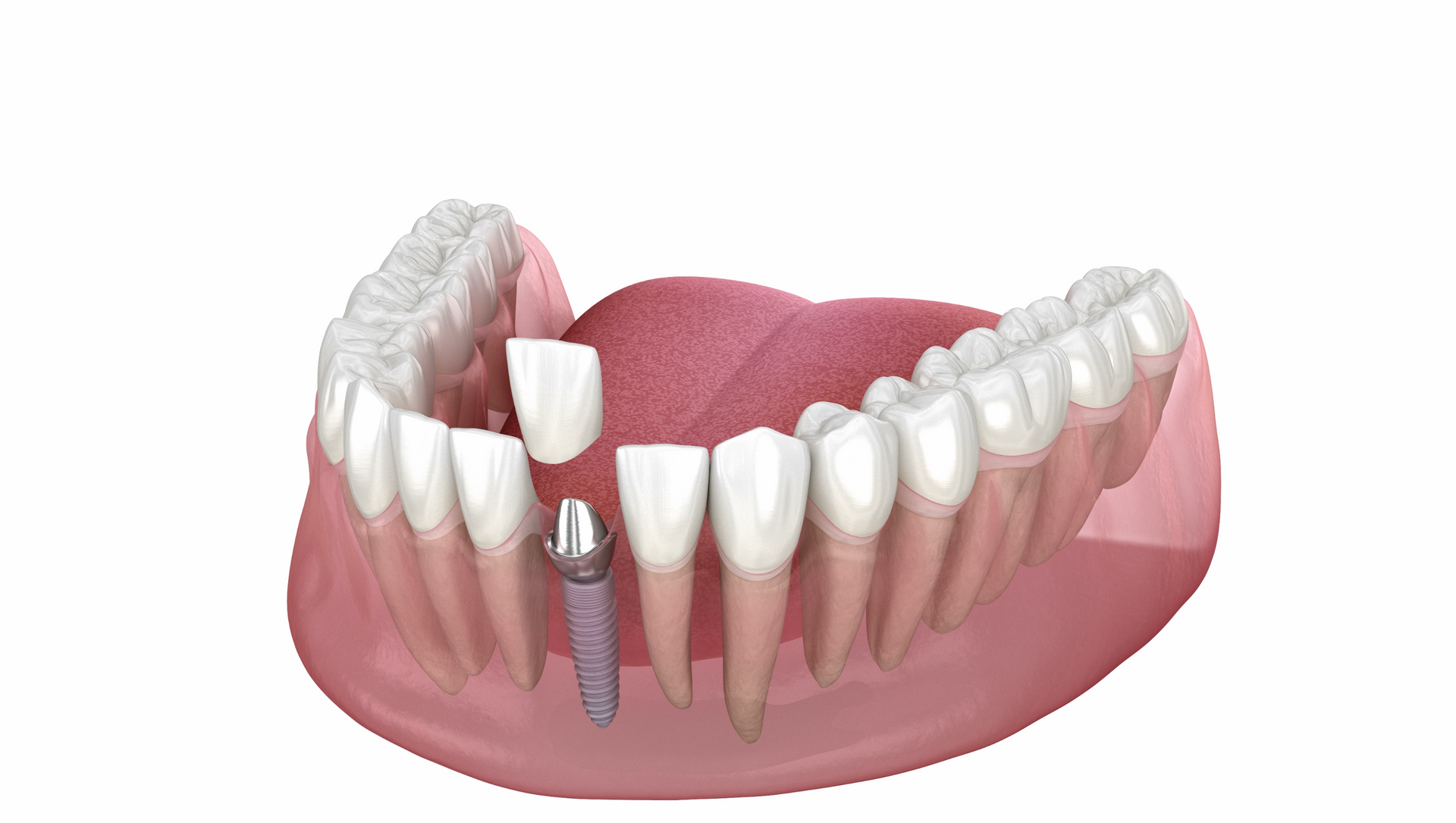 A model of a mouth with a dental implant in it.