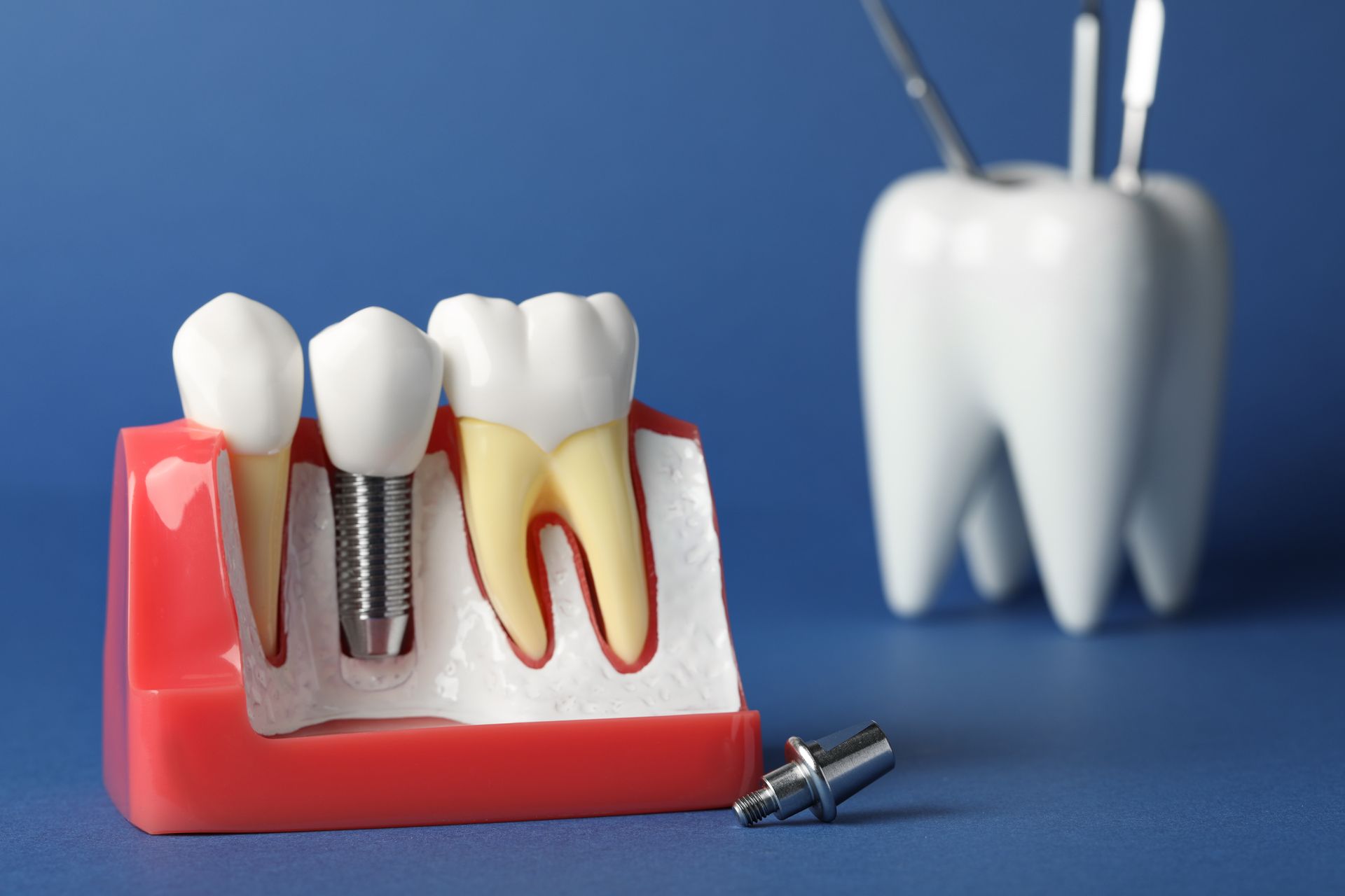Model of teeth including an implant, with dental tools and a large tooth on a blue surface.