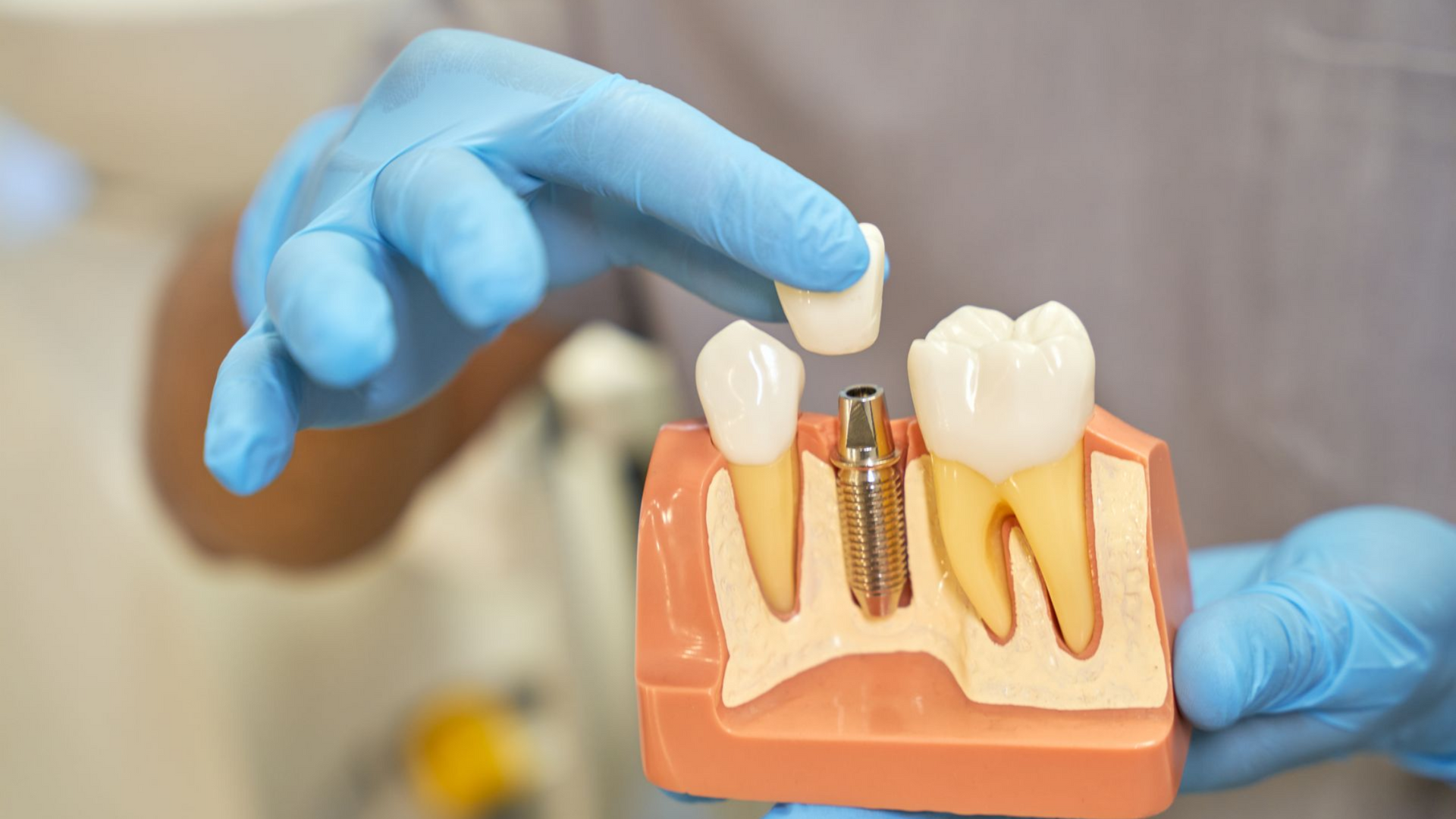 Dentist holding a model of a dental implant, showing its components and construction.