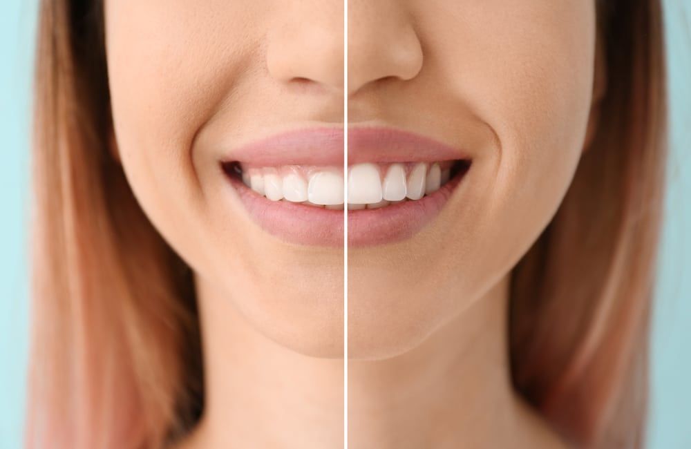 A woman 's smile before and after whitening her teeth.