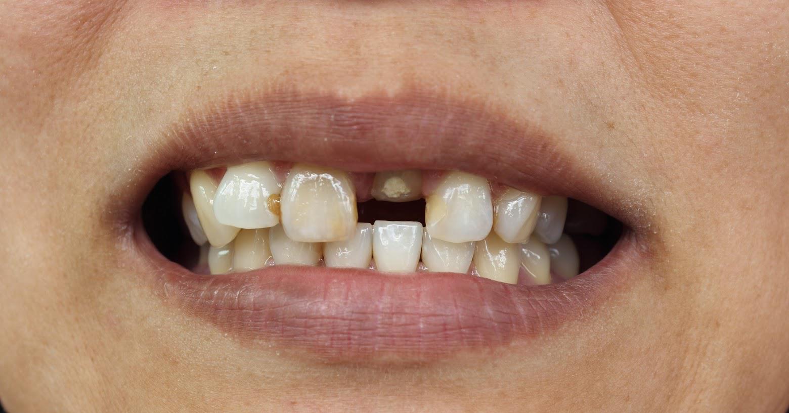 Malnourished Teeth — Naples, FL — Bradley Piotrowski, DDS, MSD, LLC