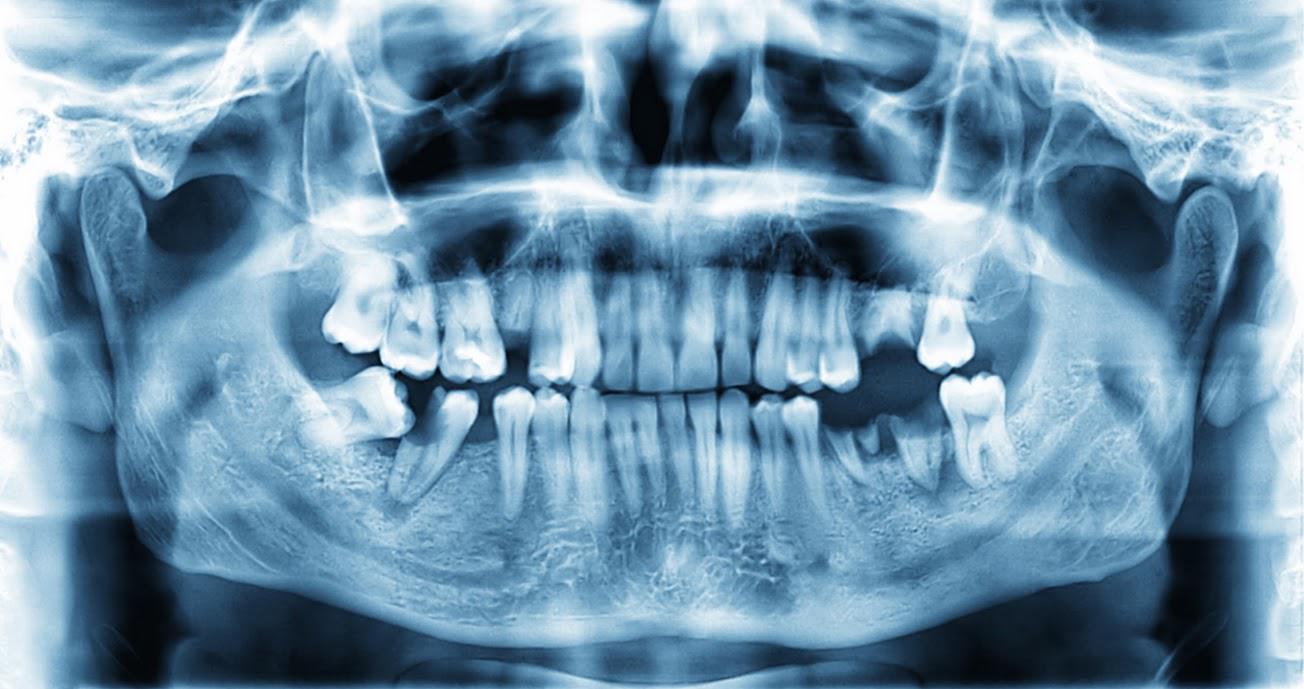 X-Ray Of Human Teeth — Naples, FL — Bradley Piotrowski, DDS, MSD, LLC