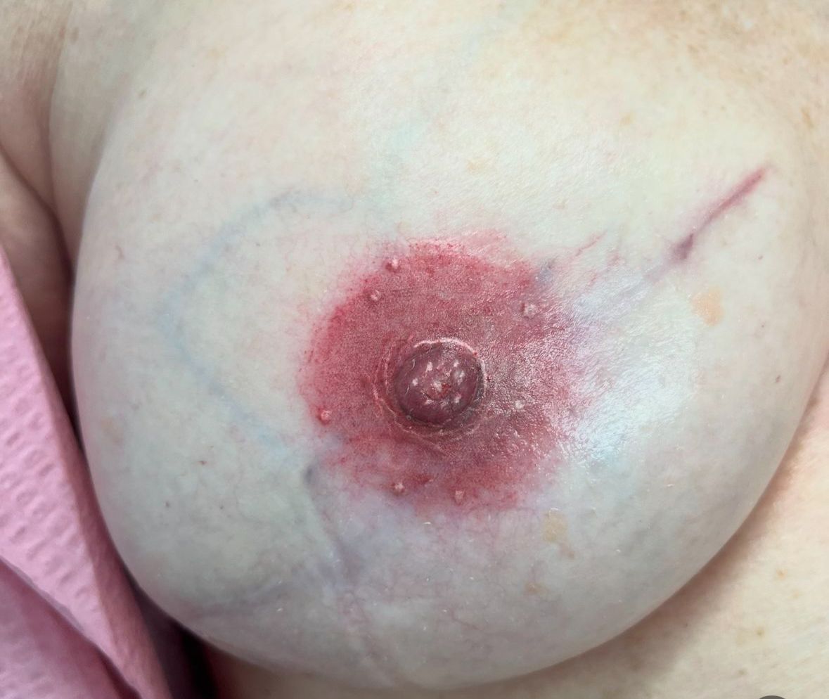  a restored areola