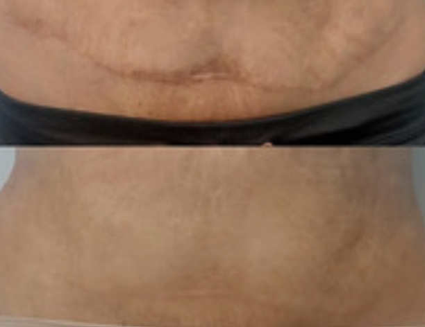woman with camouflaged scar