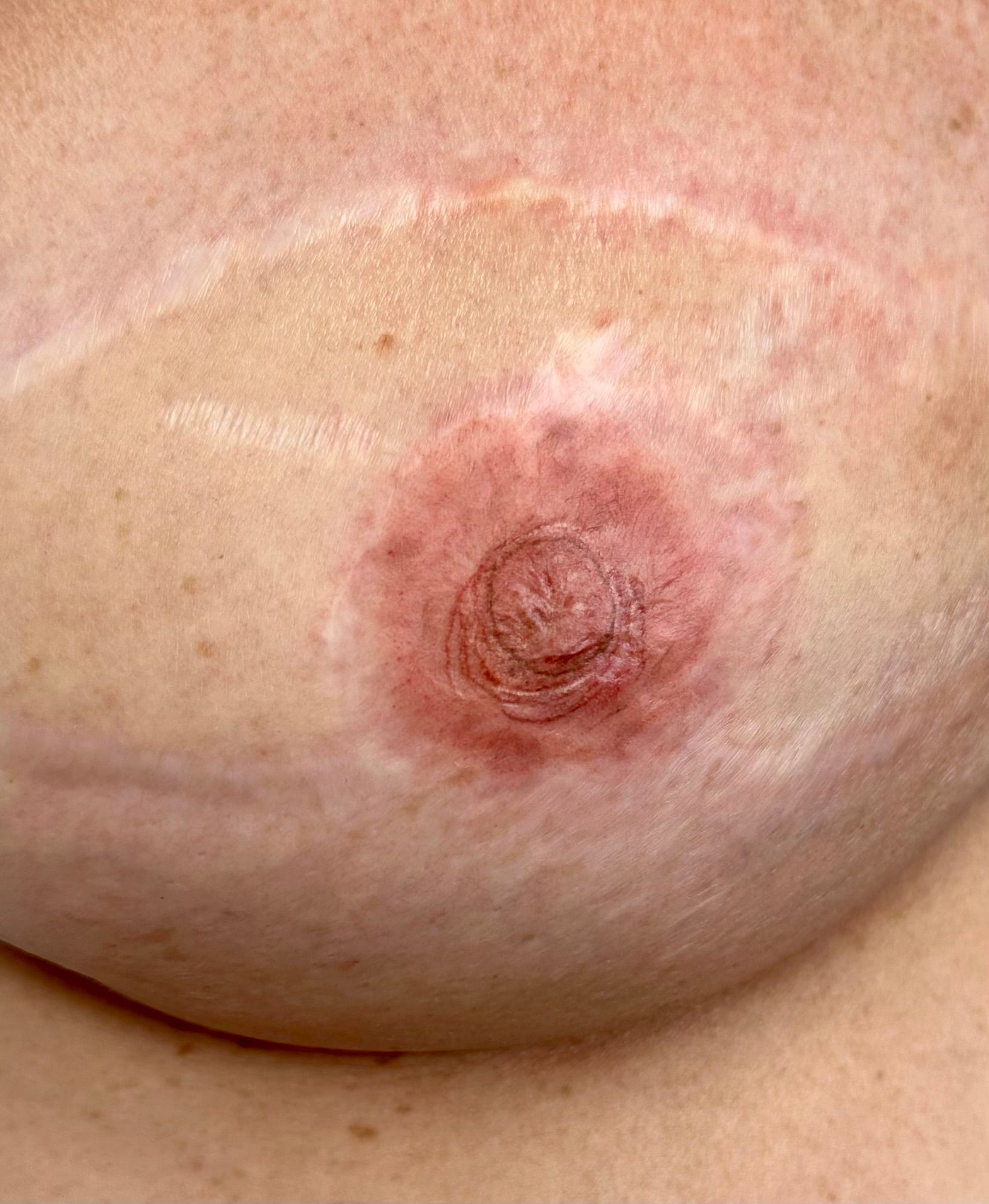 a restored areola