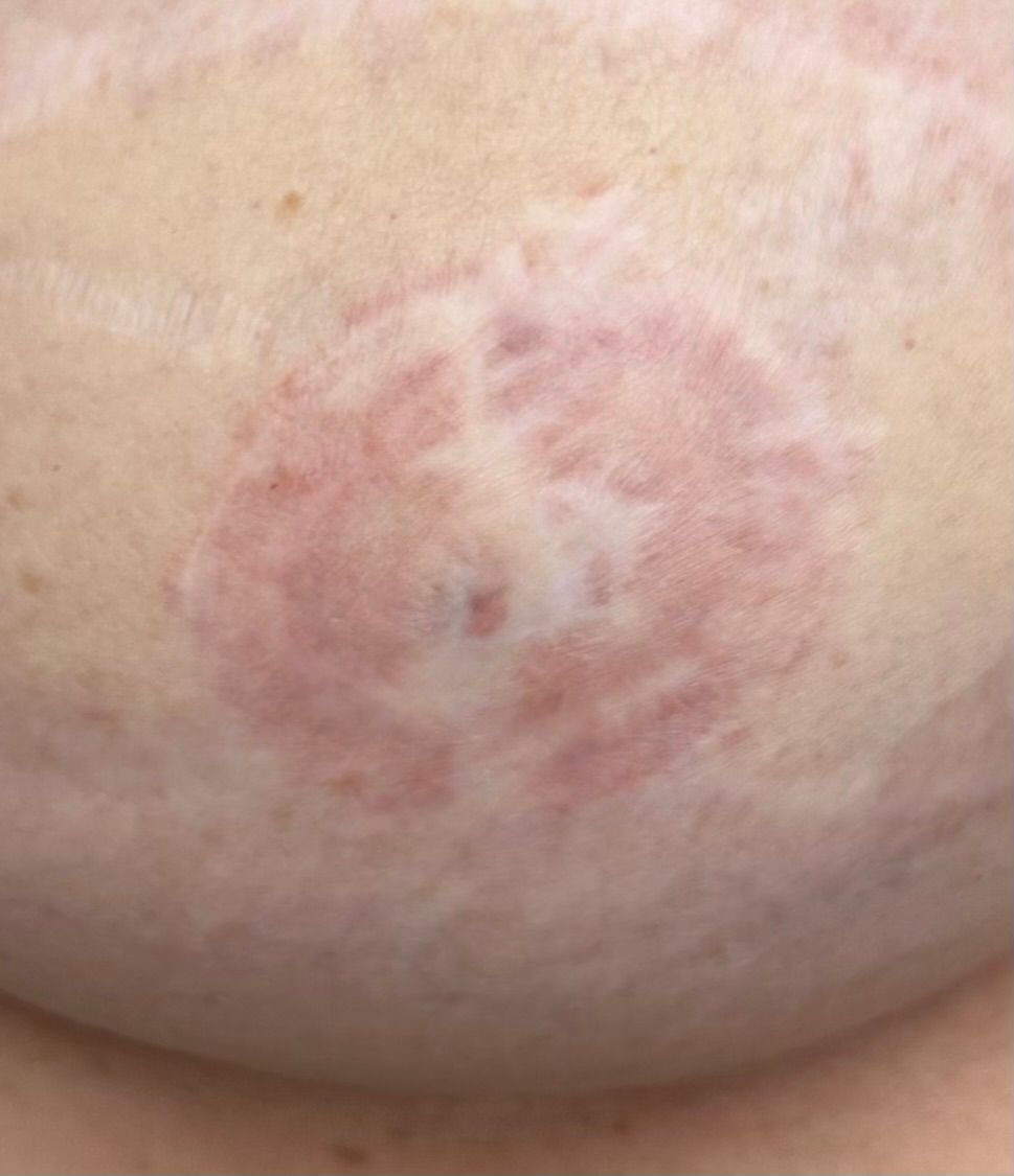 A faded areola