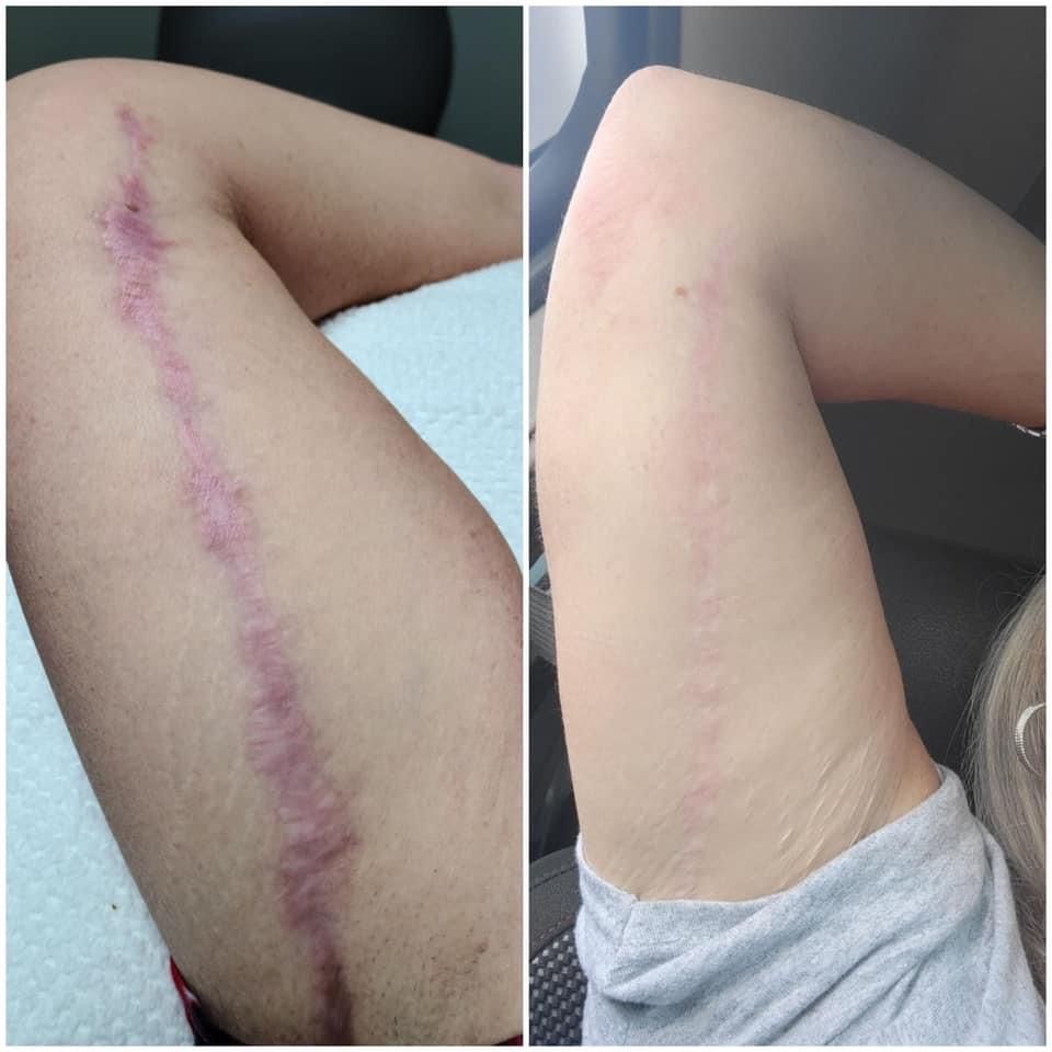 A woman has a scar on her leg and arm