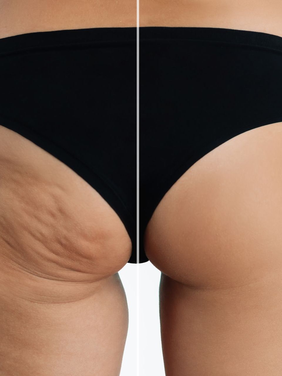 a before and after of stretch marks