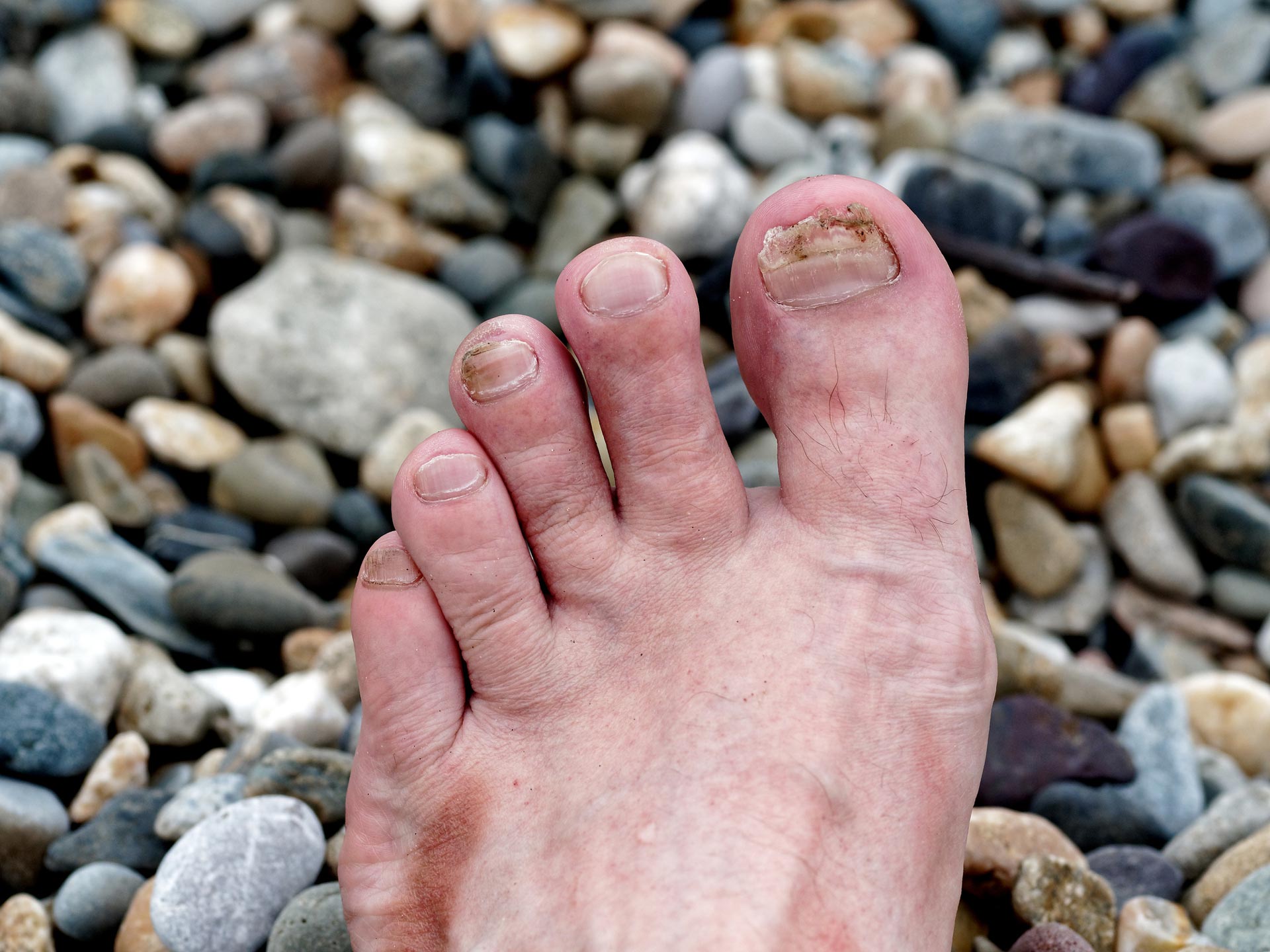 Male Toes with Damaged Nails Against the Pebble Background | Central Coast, Nsw | Angela Green Podiatry