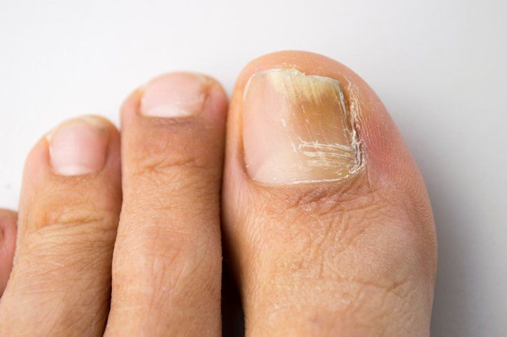 Fungal Nail Infection | Central Coast, Nsw | Angela Green Podiatry